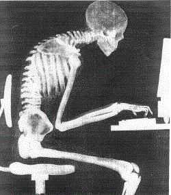Slumped posture X-ray