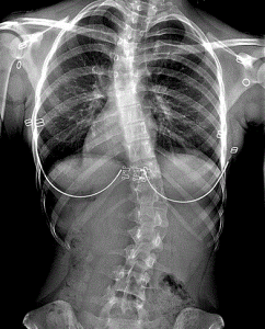 Scoliosis