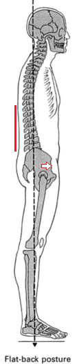 Flat back taken from Muscles Testing and Function with Posture and Pain by Kendall