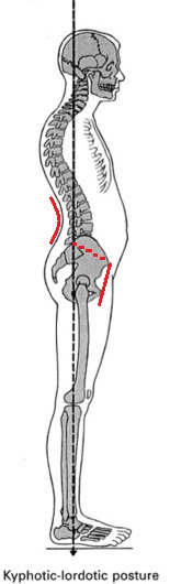 Lordosis taken from Muscles Testing and Function with Posture and Pain by Kendall