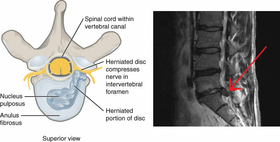 Disk herniation thanks to OpenStax College for the use of this image